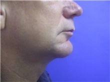Chin Augmentation After Photo by Stanley Castor, MD; Tampa, FL - Case 39528