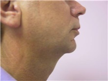 Chin Augmentation Before Photo by Stanley Castor, MD; Tampa, FL - Case 39528
