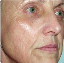 Laser Skin Resurfacing After Photo by Stanley Castor, MD; Tampa, FL - Case 39535