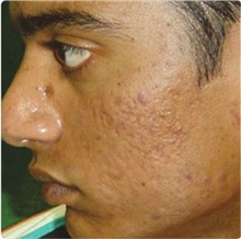 Laser Skin Resurfacing After Photo by Stanley Castor, MD; Tampa, FL - Case 39537