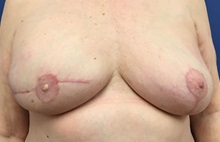 Breast Reconstruction After Photo by Daniel Sherick, MD; Ann Arbor, MI - Case 35664