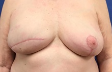 Breast Reconstruction Before Photo by Daniel Sherick, MD; Ann Arbor, MI - Case 35664