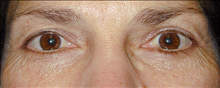 Eyelid Surgery After Photo by Daniel Mills, MD; ,  - Case 24562
