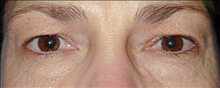 Eyelid Surgery Before Photo by Daniel Mills, MD; ,  - Case 24562