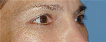 Eyelid Surgery After Photo by Daniel Mills, MD; ,  - Case 24562