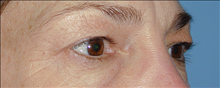 Eyelid Surgery Before Photo by Daniel Mills, MD; ,  - Case 24562