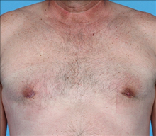 Male Breast Reduction After Photo by Daniel Mills, MD; Laguna Beach, CA - Case 24576
