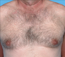 Male Breast Reduction Before Photo by Daniel Mills, MD; Laguna Beach, CA - Case 24576