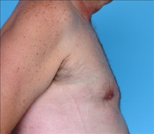 Male Breast Reduction After Photo by Daniel Mills, MD; Laguna Beach, CA - Case 24576