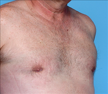 Male Breast Reduction After Photo by Daniel Mills, MD; Laguna Beach, CA - Case 24576