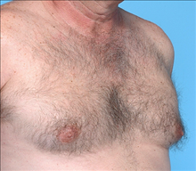 Male Breast Reduction Before Photo by Daniel Mills, MD; Laguna Beach, CA - Case 24576