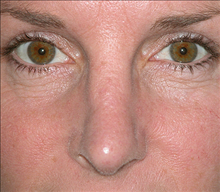 Rhinoplasty After Photo by Daniel Mills, MD; Laguna Beach, CA - Case 24580