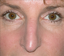Rhinoplasty Before Photo by Daniel Mills, MD; Laguna Beach, CA - Case 24580