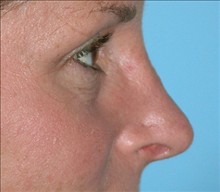 Rhinoplasty After Photo by Daniel Mills, MD; Laguna Beach, CA - Case 24580