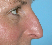 Rhinoplasty Before Photo by Daniel Mills, MD; Laguna Beach, CA - Case 24580