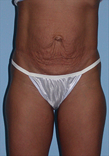Tummy Tuck Before Photo by Daniel Mills, MD; Laguna Beach, CA - Case 24583