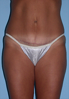 Tummy Tuck After Photo by Daniel Mills, MD; ,  - Case 24584