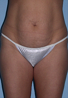 Tummy Tuck Before Photo by Daniel Mills, MD; ,  - Case 24584