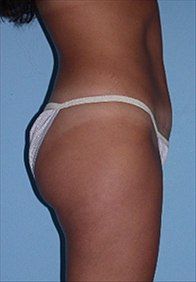 Tummy Tuck After Photo by Daniel Mills, MD; ,  - Case 24584