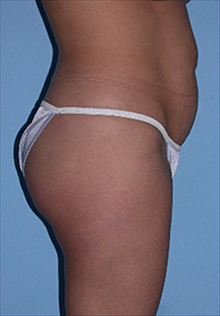 Tummy Tuck Before Photo by Daniel Mills, MD; ,  - Case 24584