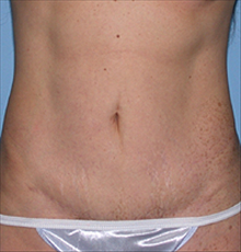 Tummy Tuck After Photo by Daniel Mills, MD; ,  - Case 24588