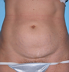 Tummy Tuck Before Photo by Daniel Mills, MD; ,  - Case 24588
