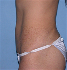 Tummy Tuck After Photo by Daniel Mills, MD; ,  - Case 24588