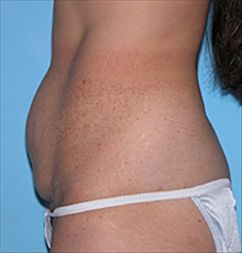Tummy Tuck Before Photo by Daniel Mills, MD; ,  - Case 24588