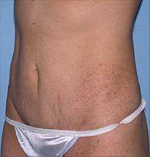 Tummy Tuck After Photo by Daniel Mills, MD; ,  - Case 24588