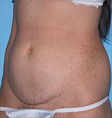 Tummy Tuck Before Photo by Daniel Mills, MD; ,  - Case 24588