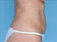 Tummy Tuck After Photo by Daniel Mills, MD; ,  - Case 24589