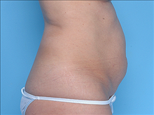Tummy Tuck Before Photo by Daniel Mills, MD; ,  - Case 24589