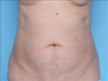 Tummy Tuck Before Photo by Daniel Mills, MD; ,  - Case 24589