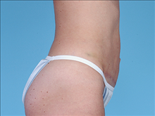 Tummy Tuck After Photo by Daniel Mills, MD; ,  - Case 24590