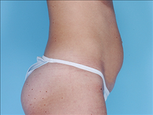 Tummy Tuck Before Photo by Daniel Mills, MD; ,  - Case 24590