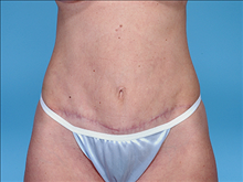 Tummy Tuck After Photo by Daniel Mills, MD; ,  - Case 24590
