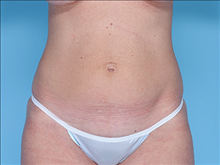 Tummy Tuck Before Photo by Daniel Mills, MD; ,  - Case 24590