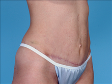 Tummy Tuck After Photo by Daniel Mills, MD; ,  - Case 24590