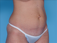 Tummy Tuck Before Photo by Daniel Mills, MD; ,  - Case 24590
