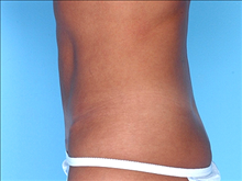 Tummy Tuck After Photo by Daniel Mills, MD; ,  - Case 24591