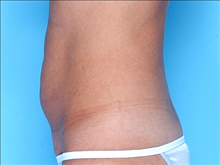 Tummy Tuck Before Photo by Daniel Mills, MD; ,  - Case 24591