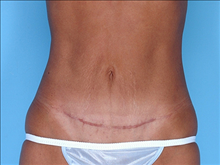 Tummy Tuck After Photo by Daniel Mills, MD; ,  - Case 24591