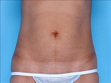 Tummy Tuck Before Photo by Daniel Mills, MD; ,  - Case 24591