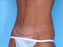Tummy Tuck After Photo by Daniel Mills, MD; ,  - Case 24591