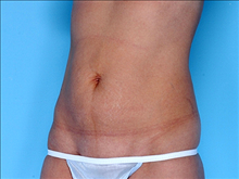 Tummy Tuck Before Photo by Daniel Mills, MD; ,  - Case 24591