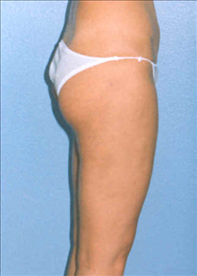 Liposuction After Photo by Daniel Mills, MD; ,  - Case 24593
