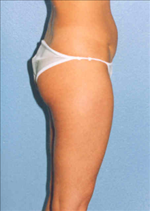 Liposuction Before Photo by Daniel Mills, MD; ,  - Case 24593