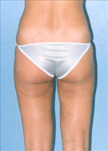Liposuction After Photo by Daniel Mills, MD; ,  - Case 24593