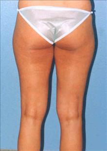 Liposuction Before Photo by Daniel Mills, MD; ,  - Case 24593
