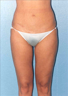 Liposuction After Photo by Daniel Mills, MD; ,  - Case 24593